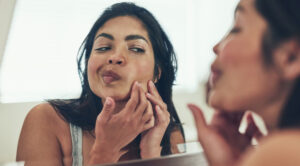 Heals Acne
